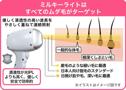 Men's ヒゲ脱毛の説明